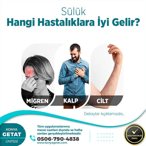 Konya Sülük Tedavisi	
